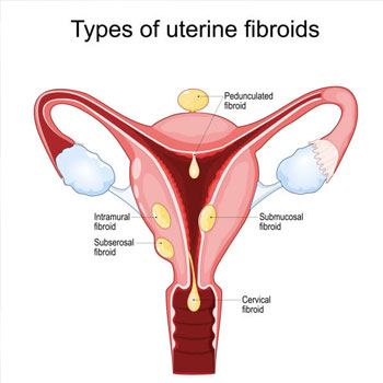 Uterine Septum / Polyp / Fibroid resection treatement in Krishna Hospital