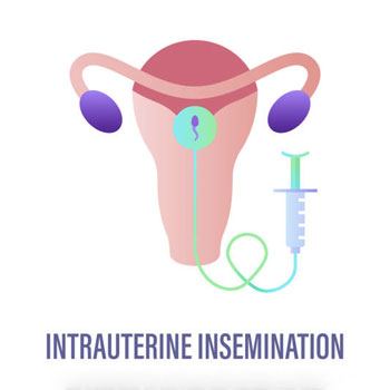 Intrauterine Insemination treatement in Krishna Hospital