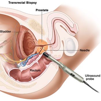 Prostatic Biopsy treatment in Krishna Hospital