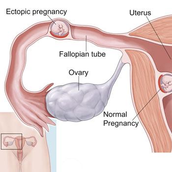 Ectopic Pregnancy treatment in Krishna Hospital