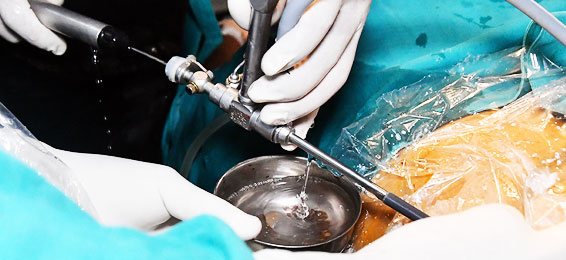 Laser Urological Surgery by Dr Mahesh Kumar Thakur